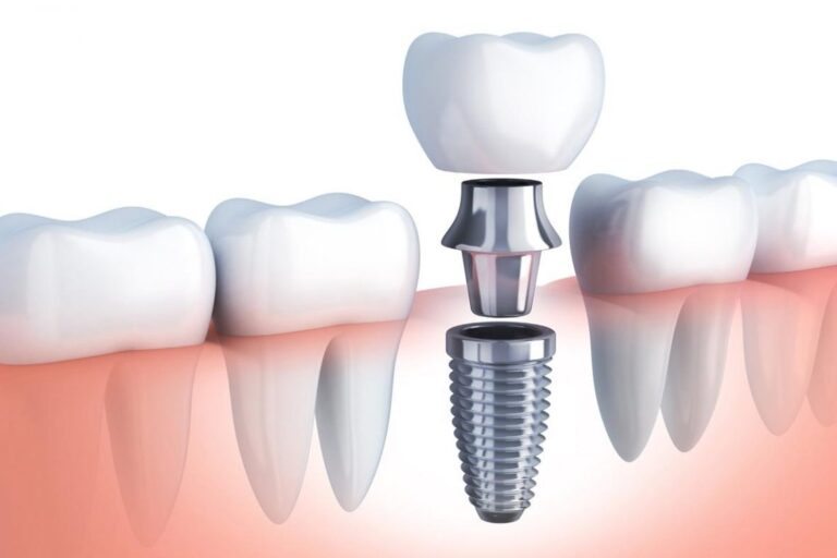 Implantes - IORC Odontologia