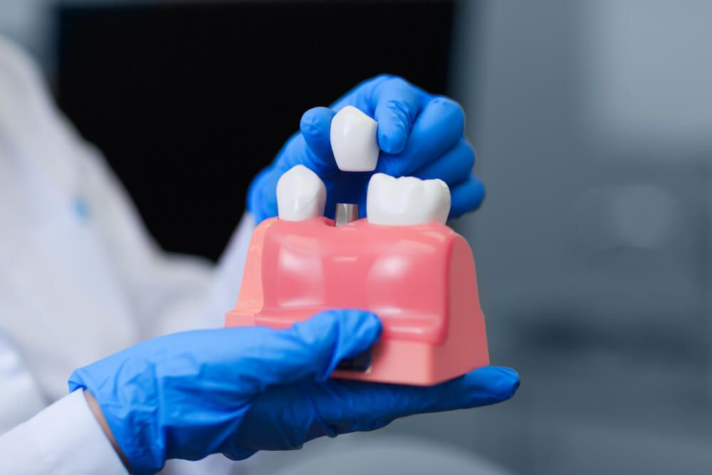 Implantes Dentários: A Solução Duradoura para Recuperar Seu Sorriso - IORC Odontologia