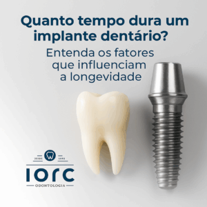 Quanto tempo dura um Implante Dentário? 1 - IORC Odontologia Quanto tempo dura um Implante Dentário? - IORC Odontologia