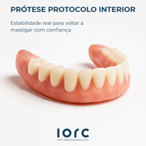 Prótese protocolo inferior: estabilidade real para mastigar com confiança - IORC Odontologia