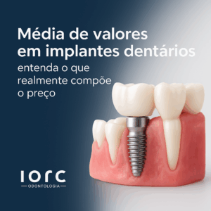 Média de valores em implantes dentários: entenda o que realmente compõe o preço 1 - IORC Odontologia Média de valores em implantes dentários: entenda o que realmente compõe o preço - IORC Odontologia