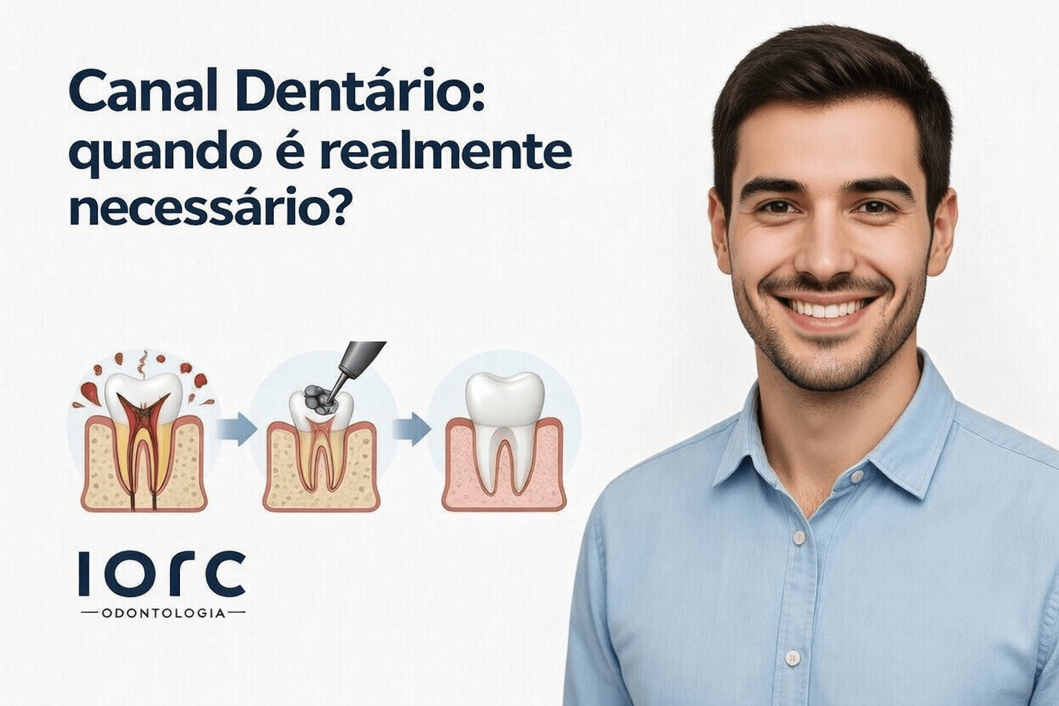 Canal Dentário: Quando é realmente necessário? - IORC Odontologia