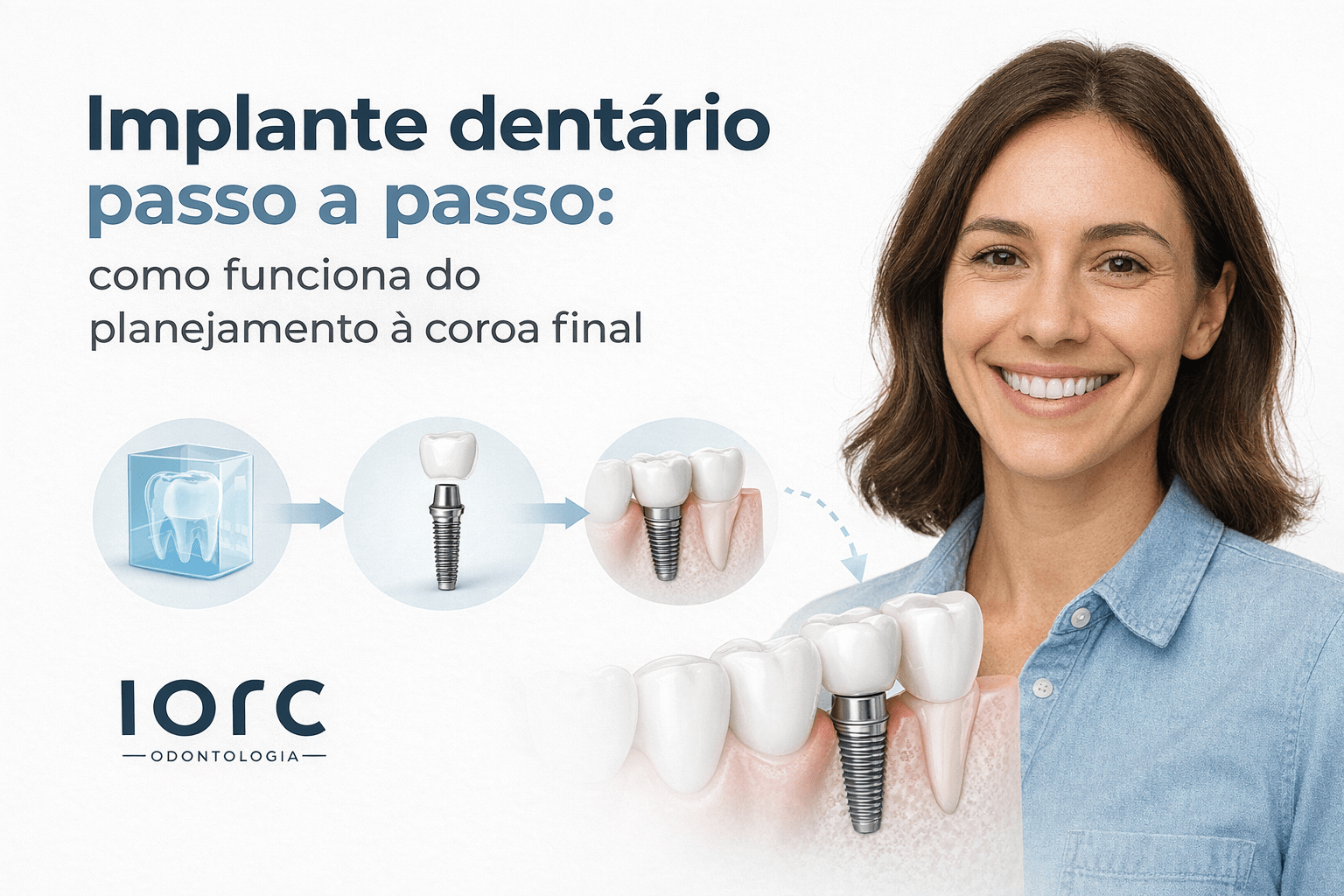 Implante dentário passo a passo: como funciona do planejamento à coroa final - IORC Odontologia