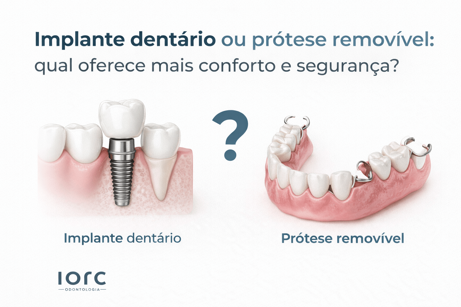 Implante dentário ou prótese removível: qual oferece mais conforto e segurança? - IORC Odontologia